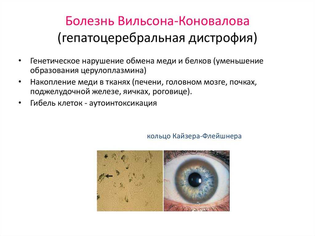 Болезнь вильсона-коновалова: симптомы, признаки, диагностика, лечение