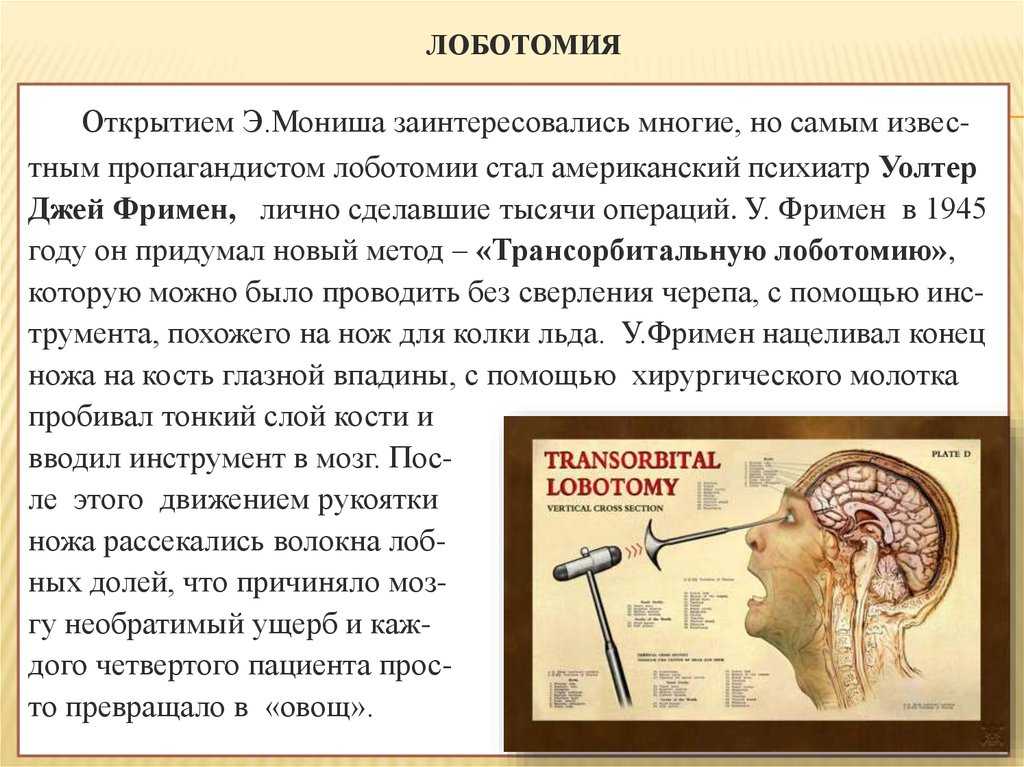 Что это такое трансорбитальная лоботомия: описание операции, процесс выполнения и последствия