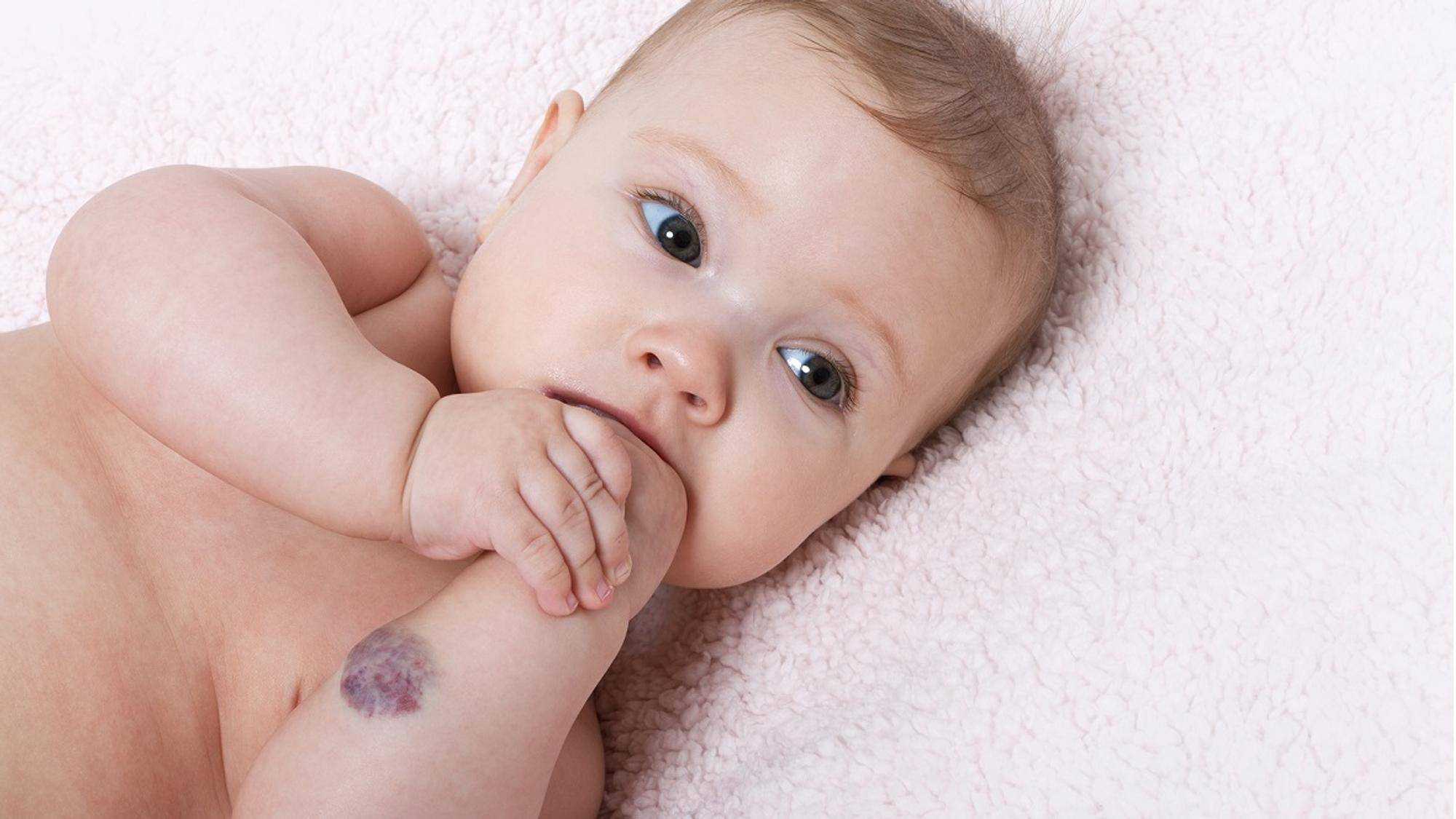 Когда у ребенка появляются родинки - mums.ru