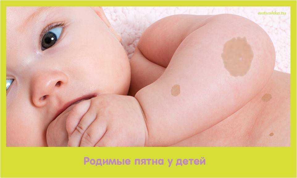 , что такое родинка, как и почему она появляется Бывают ли родинки у новорожденных