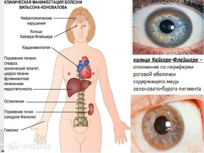 Болезнь вильсона-коновалова